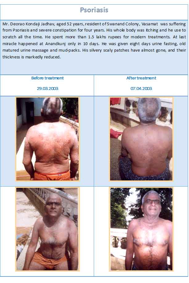 psoriasis